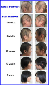 Read more about the article Stem Cells Weave Their Magic To Replace The Crowning Glory