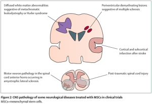 Read more about the article MSCs For Multiple Sclerosis