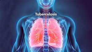 Read more about the article Mesenchymal stem cells weave magic for TB