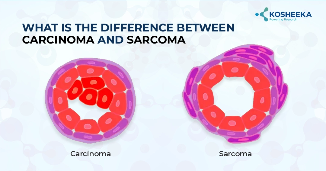You are currently viewing CARCINOMA AND SARCOMA: THE DIFFERENCE