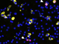 Human Bone Marrow-Derived CD 34 positive cells
